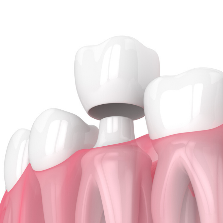 dental crown illustration