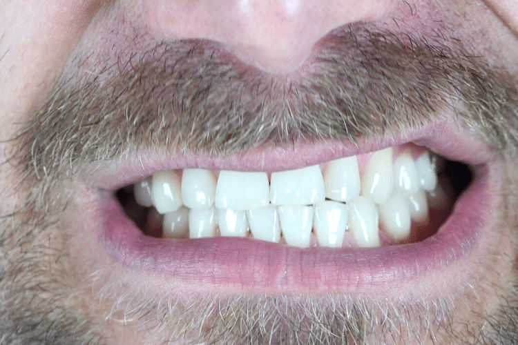 restored worn teeth of a man